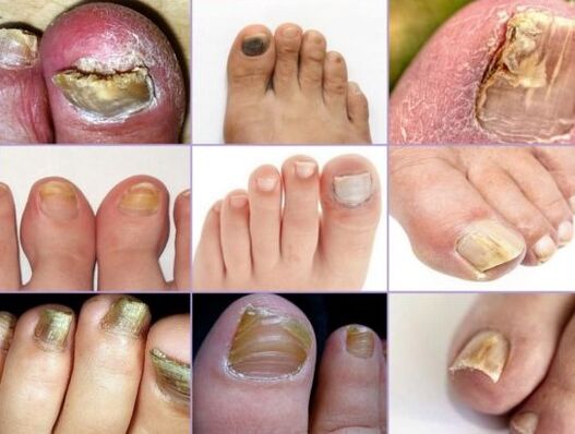 Daño de las uñas a varios tipos de hongos