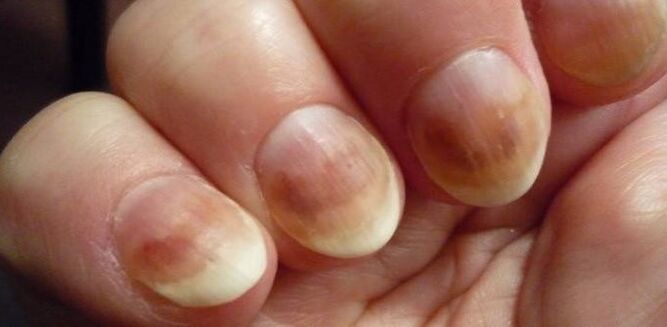 Infección con micosis de uñas