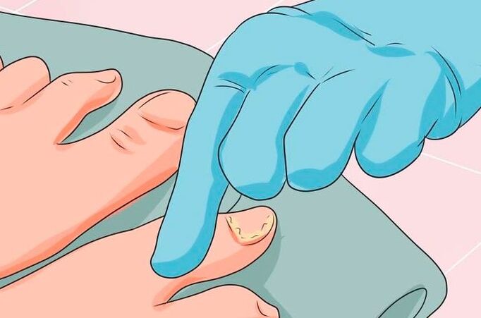 Los primeros signos de la micosis de uñas
