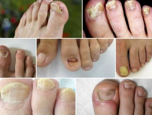 Varias formas de hongos de uñas