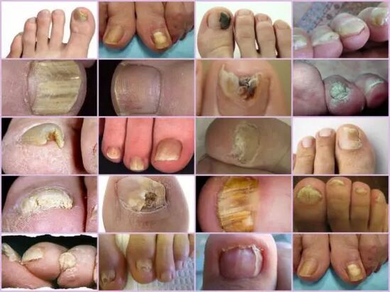 Onicomicosis de diversas localización en la uña