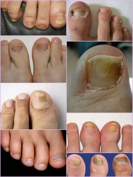Variedades de hongos de uñas