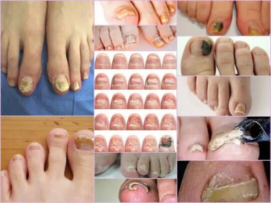 Variedades de onicomicosis