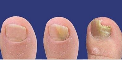 Etapas de desarrollo del hongo de uñas